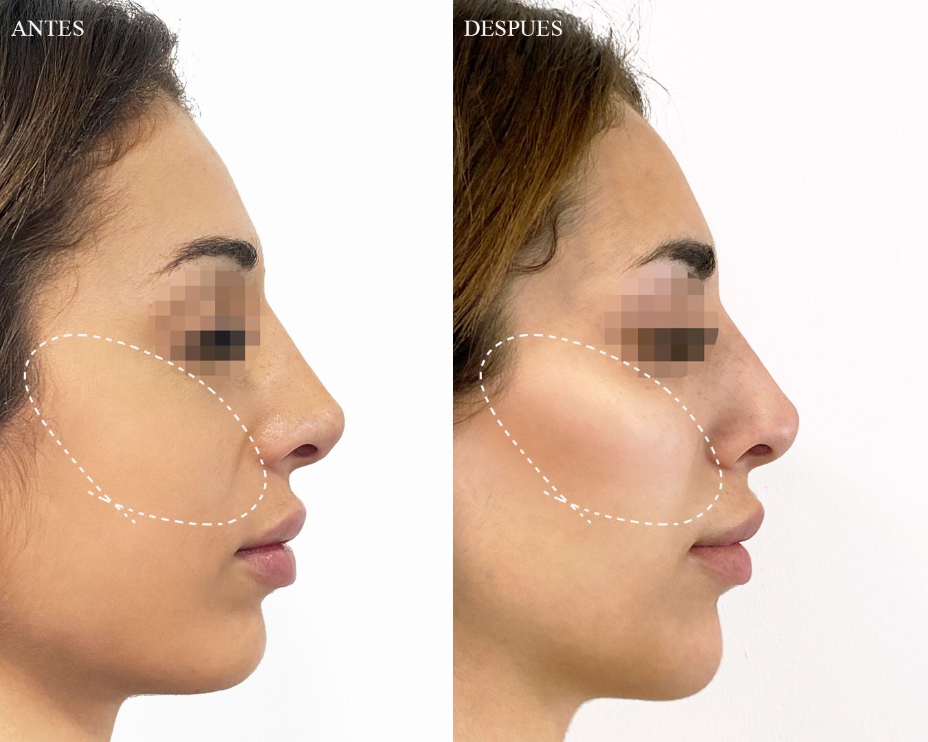 Los pómulos PERFECTOS. 5 tips que tienes que saber. Dra. Noelia Gon